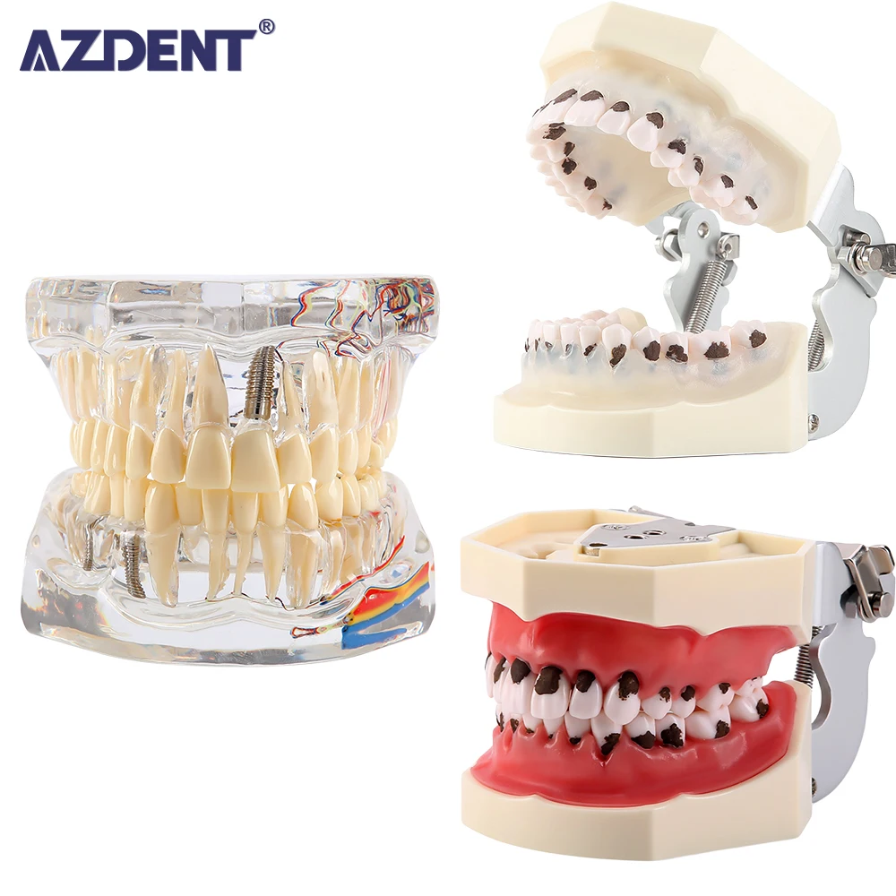 

Модель зубного камня AZDENT стоматологический периодонтальный модель болезни зубной нервный ремонт зубной имплантат патологический фитинг модель головки