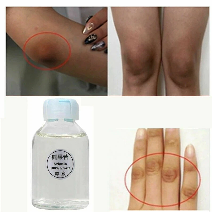 

Отбеливающая отбеливающая Сыворотка для темной кожи с койевой кислотой