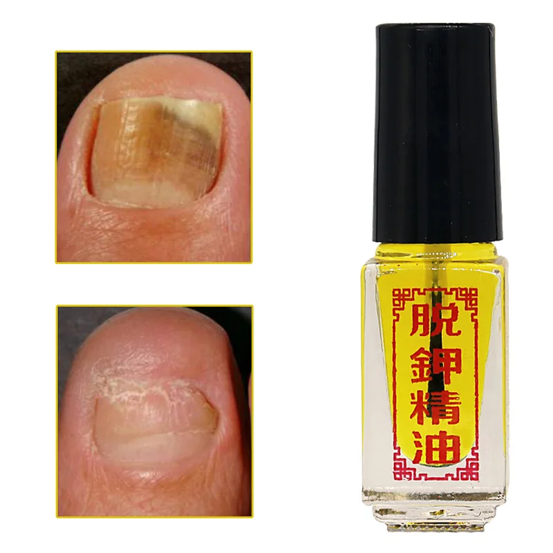 

2022 new 3 Days Effect Treatment Removal of onychomycosis Paronychia Anti oil Fungal Nail Infection Toe Nail Fungus oil Care