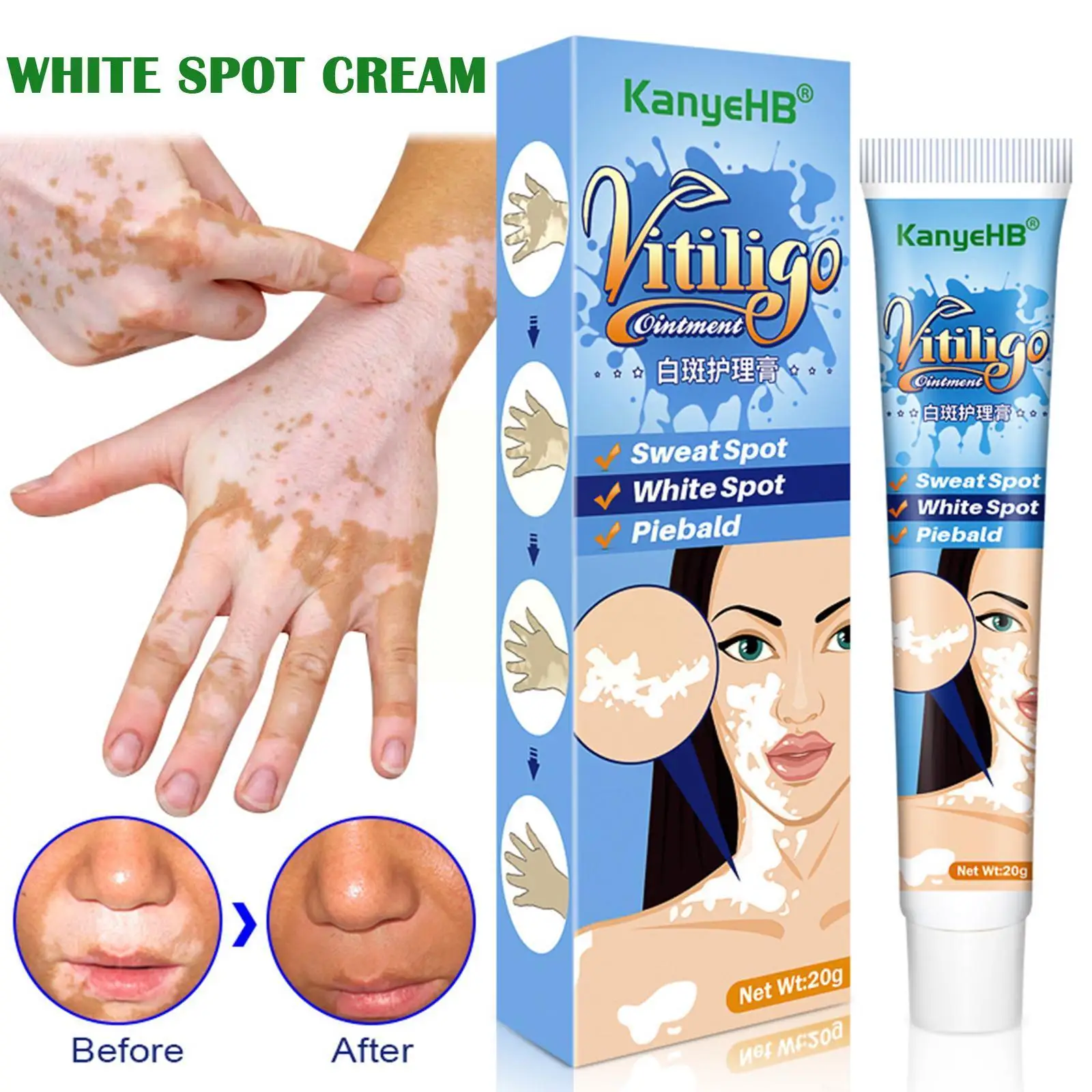

Травяной экстракт Vitiligo, мазь для удаления червячьей кожи, крем для восстановления и лечения точечной лейкоплатии, лечение белой болезни уда...