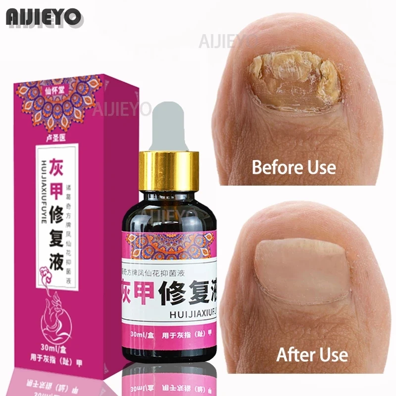 

Средство для лечения грибков ногтей, эссенция для ухода за ногами, отбеливание ногтей на ногах, удаление грибка на ногтях, антиинфекционный ...