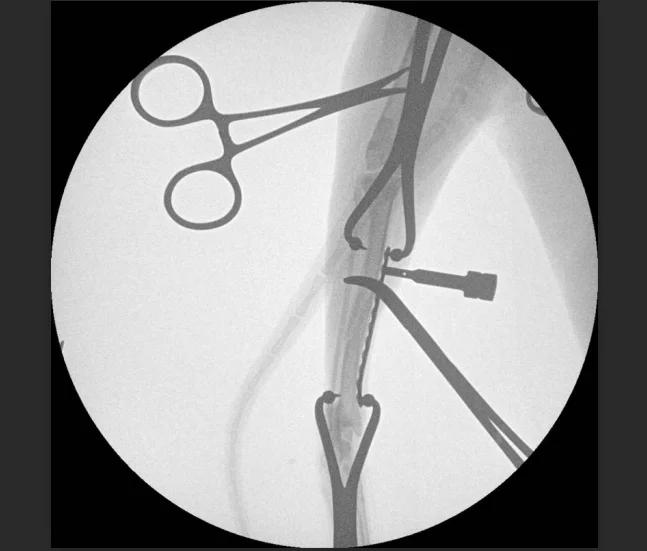 Рисунок 6 - Высокочастотная Мобильная система C-arm