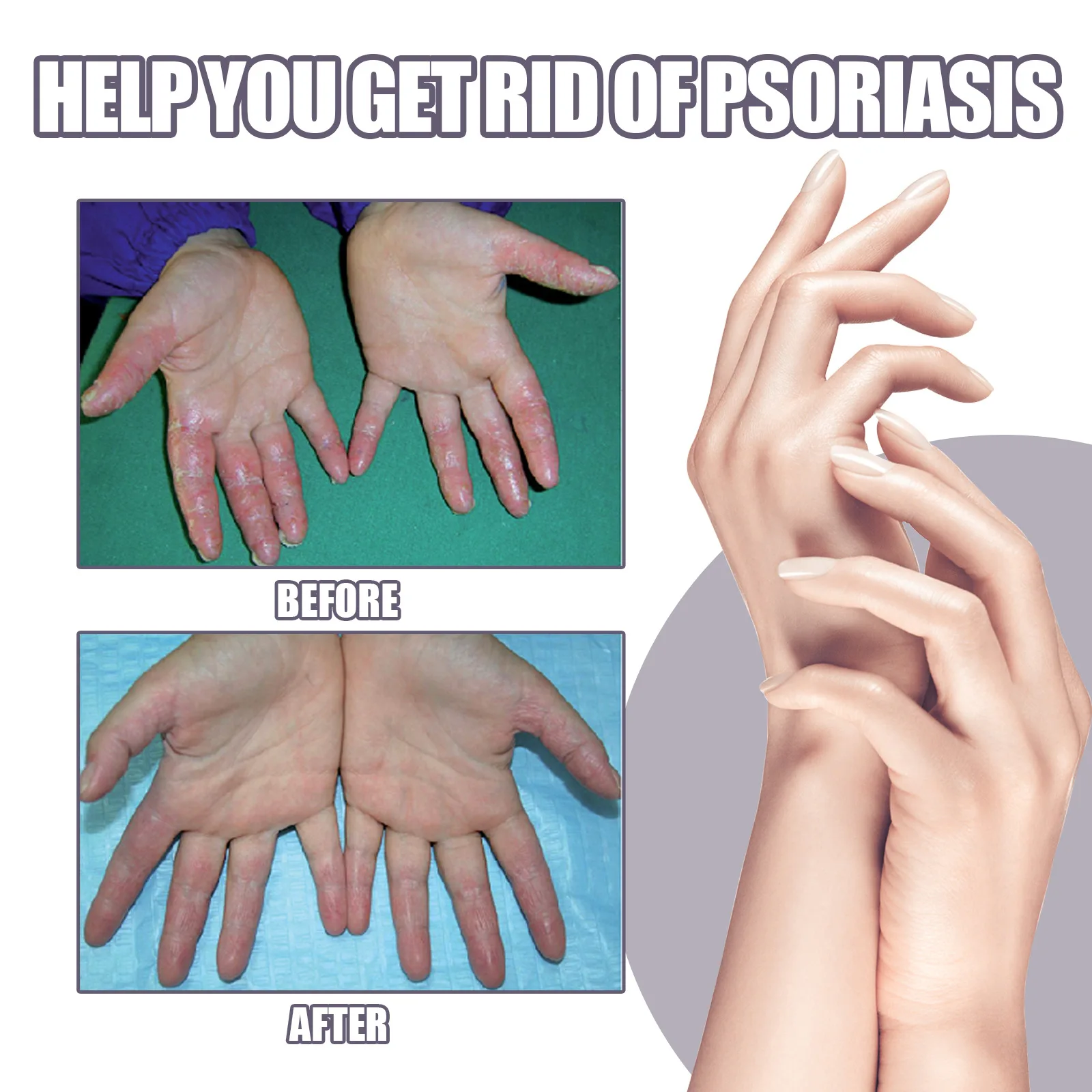 Рисунок 5 - Спрей для лечения псориаза