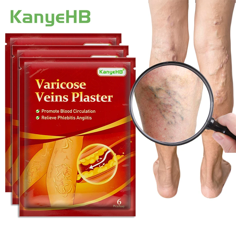 

18pcs=3bags Chinese Varicose Veins Plaster Vasculitis Phlebitis Angiitis Spider Web Vein Removal Varicosity Medical Patch A594