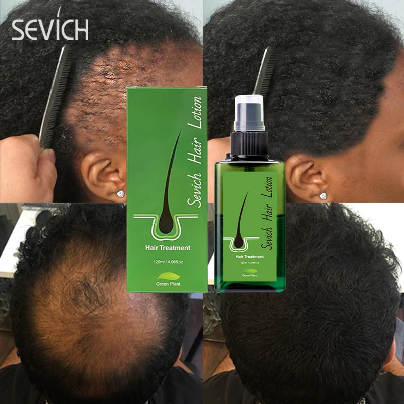 120ml Anti Hair Loss Treatment Essence For Men Women Fast Regrowth Oil Scalp Care Product