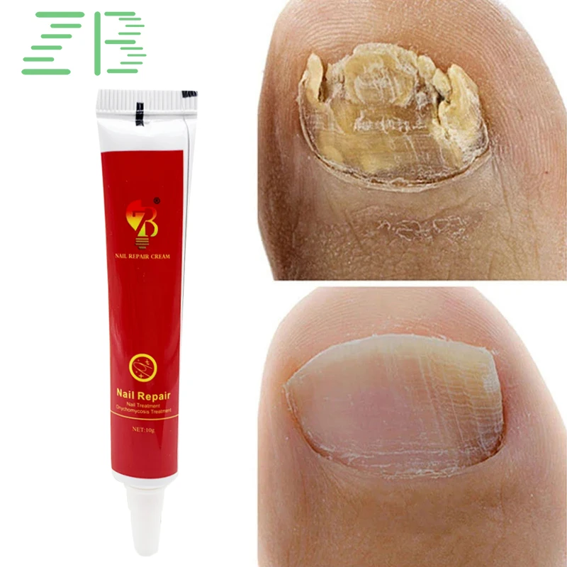 

1Pcs Nail Fungal Treatment Ointment Anti Infection Paronychia Onychomycosis Foot Toe Nail Fungus Removal Cream Feet Health Care