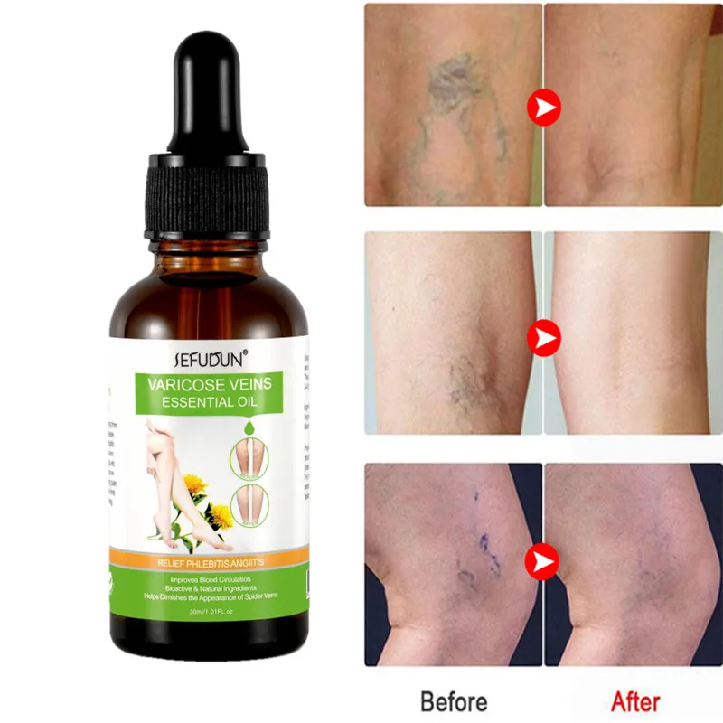 

Natural Essential Oil Varicose Vein Repair Vasculitis Phlebitis Massage Relieve Swelling Nourish Mineral Vegetable Oil 30ML