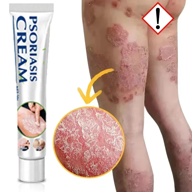 1 шт. крем для кожи от псориаза 100% оригинальный травяной пластырь дерматита