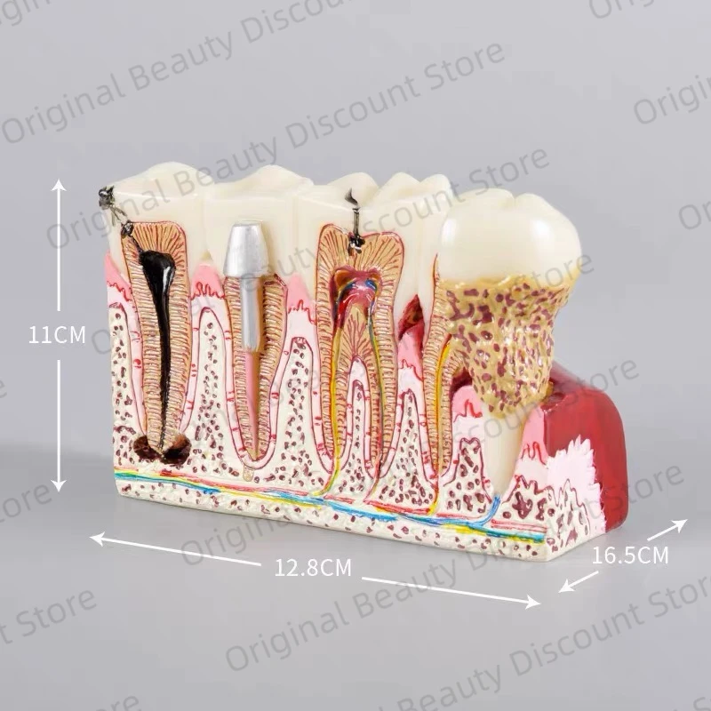 

Dental Implant Demonstration Model Teeth Study Teach Disease Analysis with Restoration Crown Bridge Maxillary Mandibular