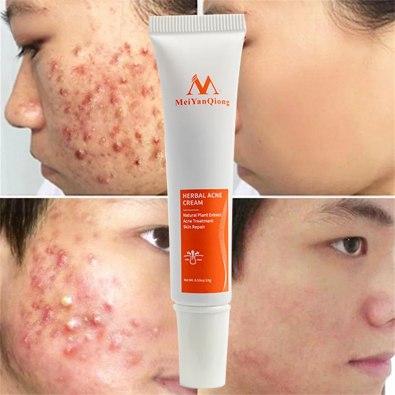 

Herbal Acne Removal Cream Treatment Acne Scar Spots Face Gel Anti-Acne Shrink Pores Oil Control Moisturizing Whitening Skin Care