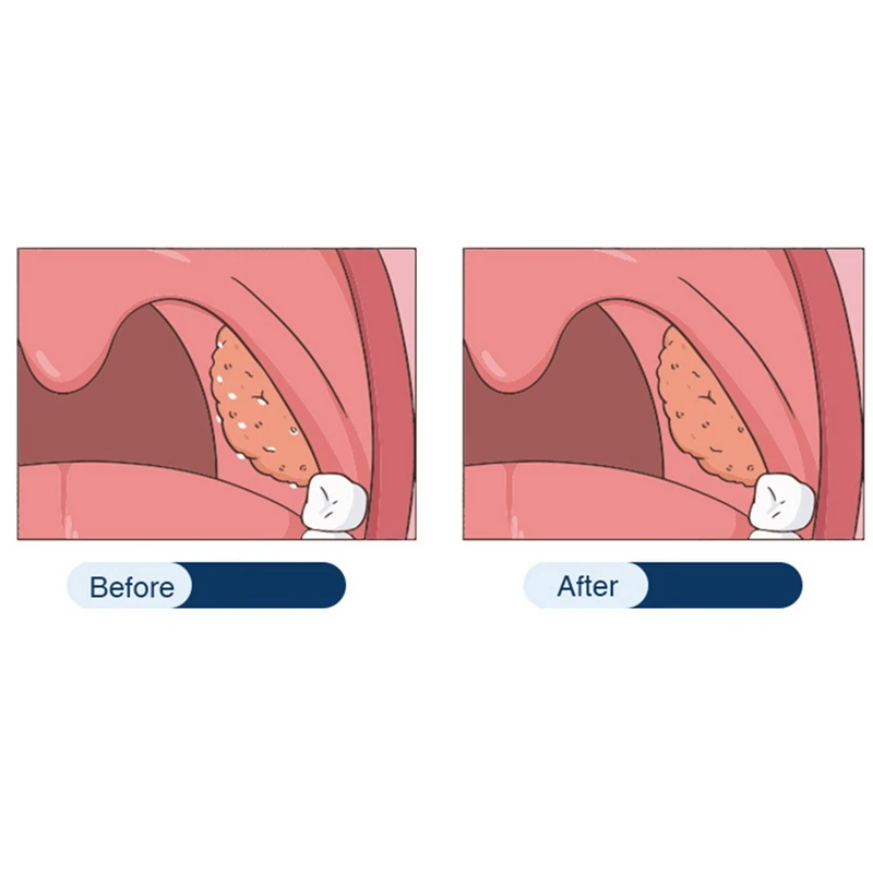 Электронный вакуум для удаления камней из миндаля набор инструмент с миктєвым