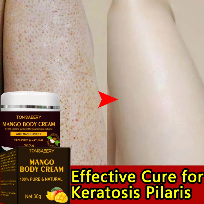 Эффективный Лечебный крем для кератоза Pilaris