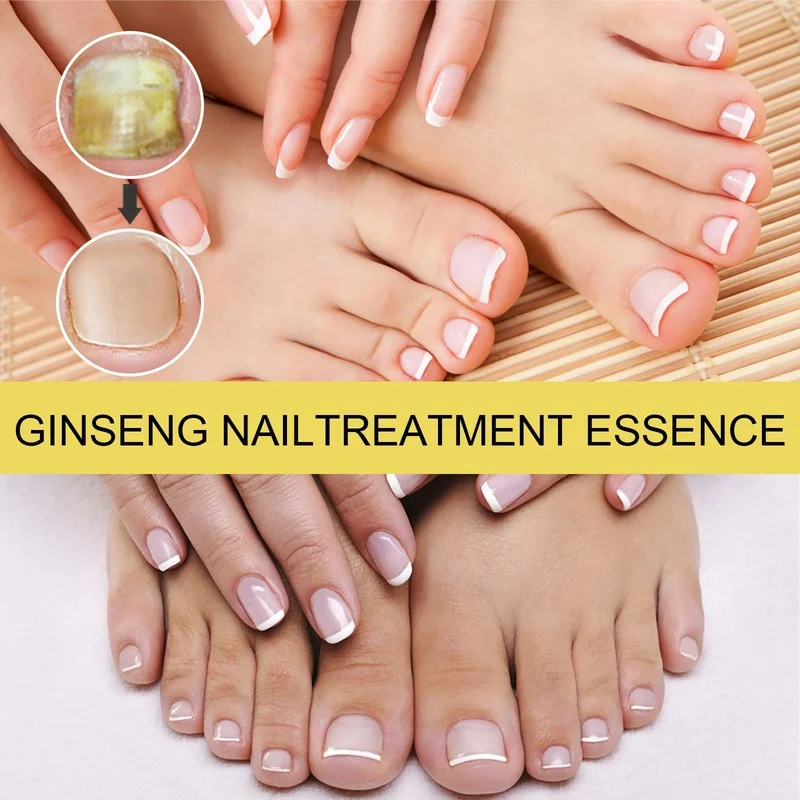 30ml Nail Fungal Treatment Spray Feet Repair Serum Nails Foot Toe Fungus Removal Gel Anti Infection Paronychia Onychomycosis (art.: 3920bbf465bbf) - 3920bbf465bbf