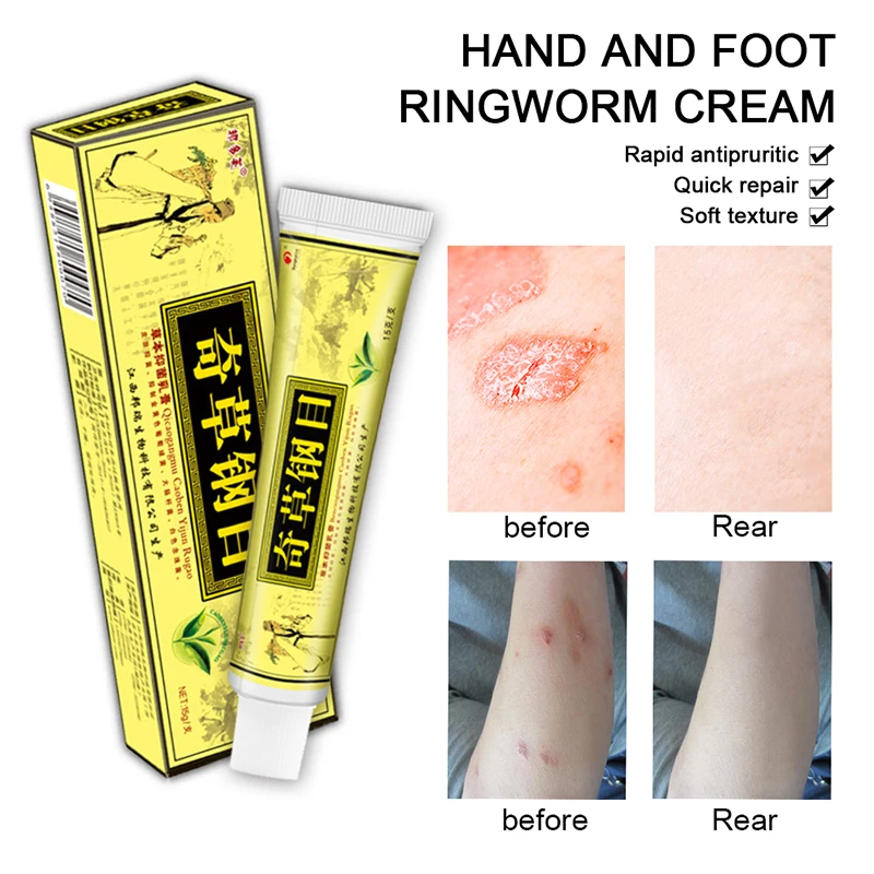 

10pcs QICAOGANGMU Psoriasis Cream Itchy Skin Cure Cream Yiganerjing Dermatitis Eczematoid Ointment Treatment Cream Dropshipping