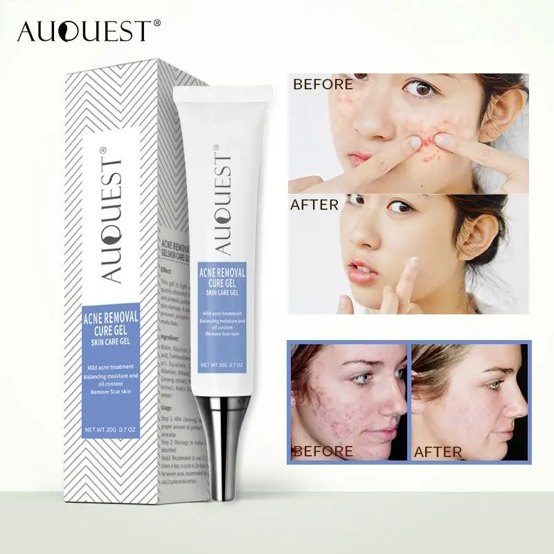 

AUQUEST Acne Cream Fade Blemish Acne Gel Cream Concealer Moisturizing Moisturizing Cream Facial Skin Repair 20g