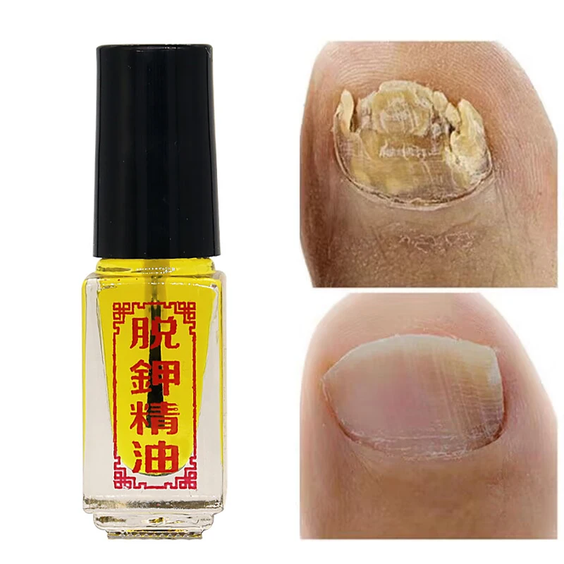 

3 Days Effect Nail Fungal Treatment Oil Anti Infection Removal Onychomycosis Paronychia Gel Toe Nails Fungus Oil Care Products M