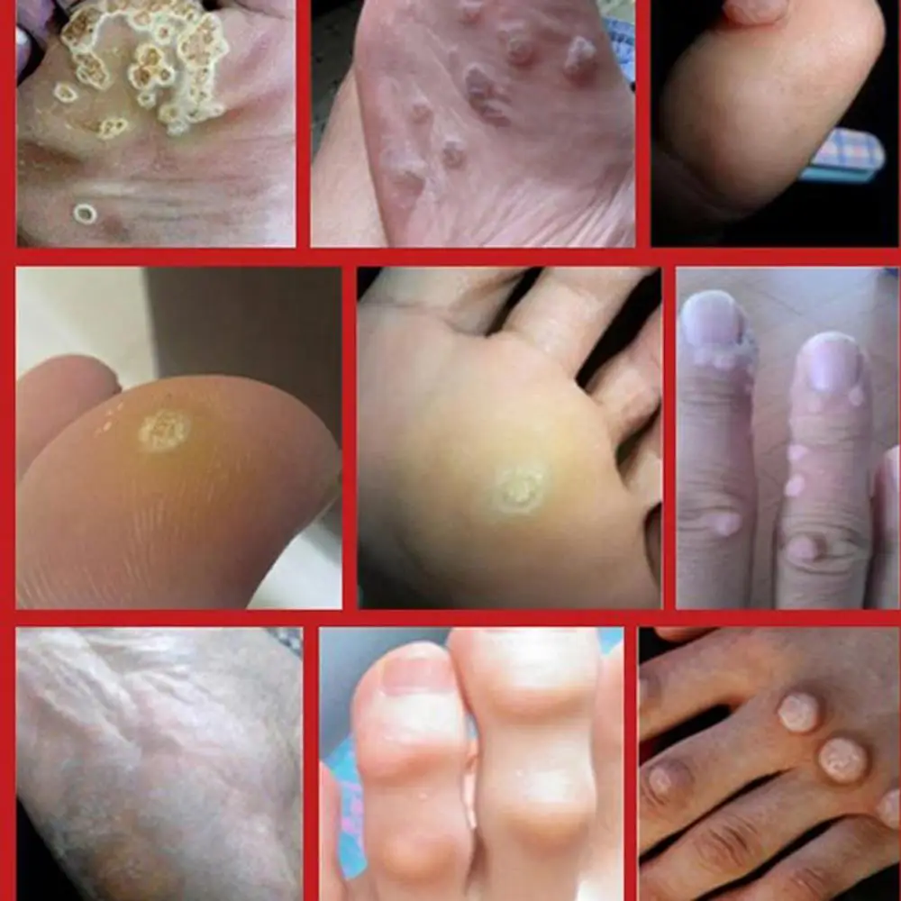 

2 шт., пластыри для удаления ороговевшей кожи и мозолей