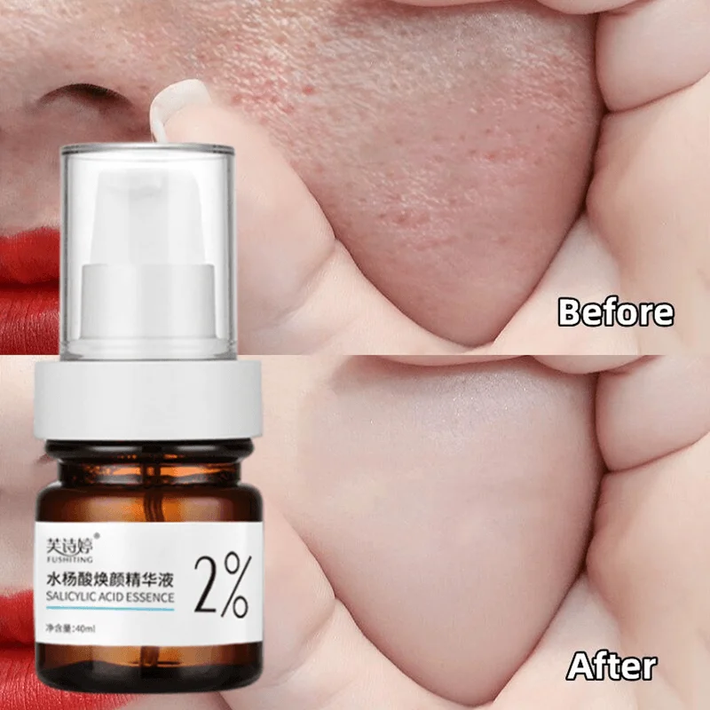 

Mildest %2 Salicylic Acid Shrink Pore Face Serum Acne Blackhead Removal Essence Whiten Brighten Spots Deep Moisturize Skin Care