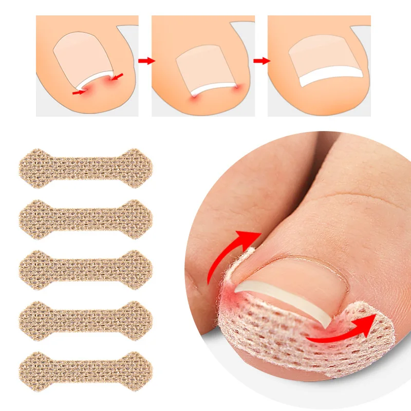 

5Sheet Ingrown Toenail Corrector Sticker Foot Care Paronychia Treatment Pedicure Toe Thumb Orthodontic Ingrown Nail Care Patches