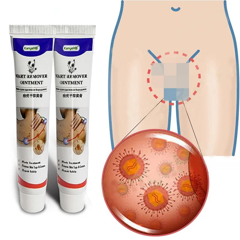 

2pcs Genital Wart Remover Ointmen Vulva Condyloma Antibacterial Treatment Cream For Male & Female Papilloma Warts Skin Tag