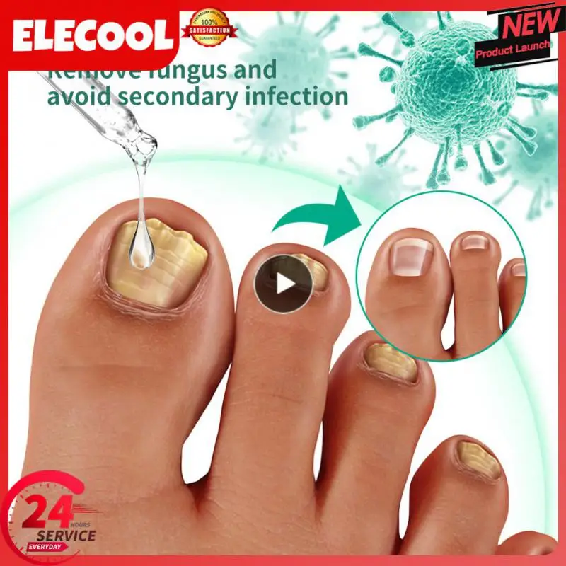 

OUHOE Toenail Fungal Feet Care Nail Foot Whitening Toe Nail Repair Fungus Removal Gel Anti Paronychia Onychomycosis Feet Cares