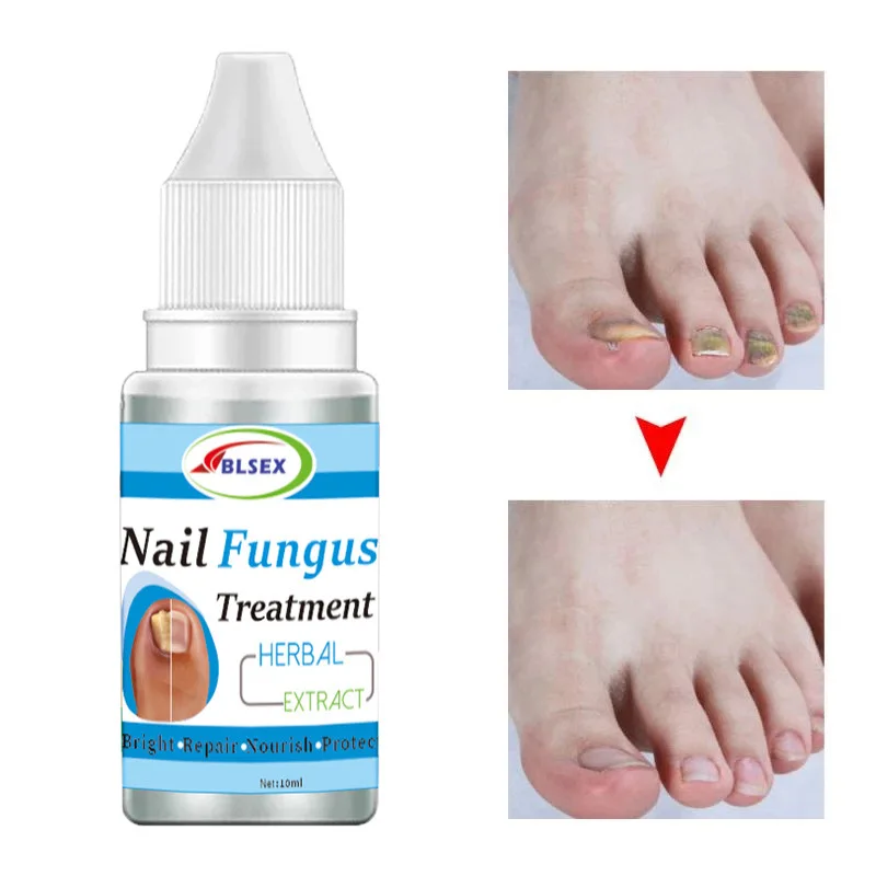 

Effective Nail Fungal Treatment Serum Anti Infection Toe Fungus Hand Foot Removal Repair Gel Care Onychomycosis Paronychia 10ml