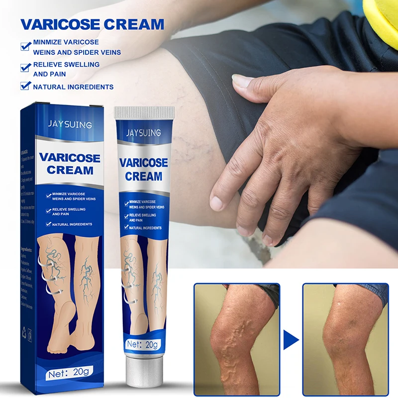 

Varicose Vein Treatment Cream Herbal Relief Tired Leg Dilated Vasculitis Phlebitis Spider Shape Vein Pain Ointment 20g Body Care