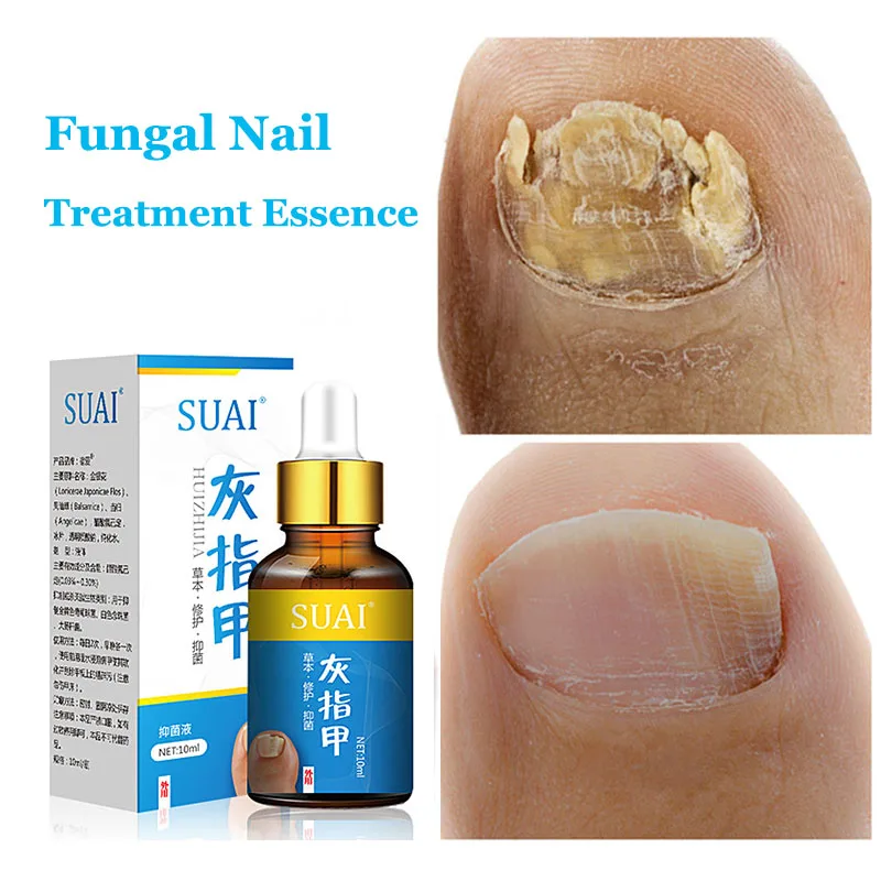 Средство от грибка ногтей. Средство от грибка ногтей. Fungal treatment solution для ногтей. Средство против грибка ногтей на ногах. Лечение ногтей на ногах препараты отзывы.