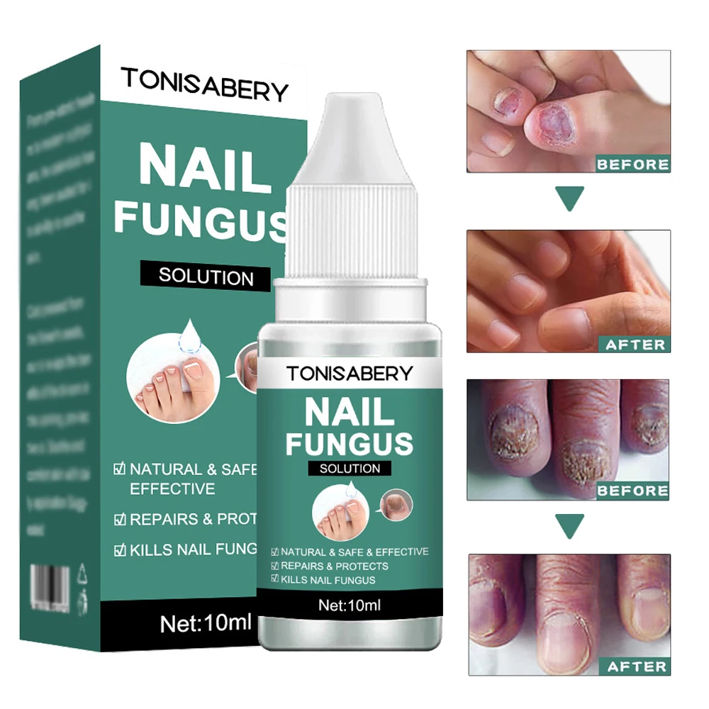 

10 мл грибковая эссенция для восстановления ногтей Сыворотка для ухода за ногтями лечение грибок для ног удаление гель против инфекции паро...