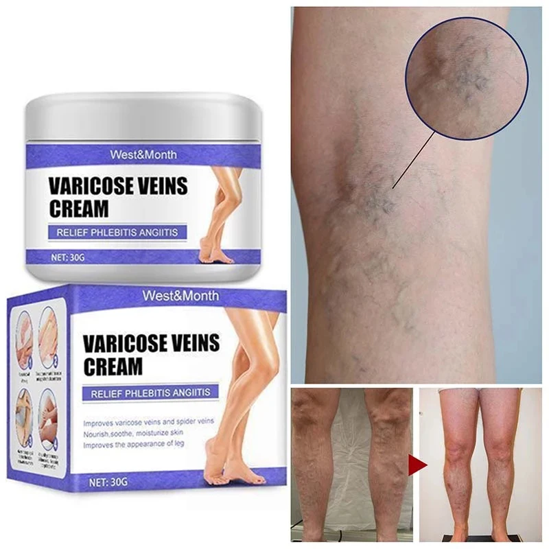 

Varicose Veins Relief Cream Leg Vasculitis Phlebitis Spider Pain Relief Treatment Ointment Medical Plaster Beauty Body Care 30g