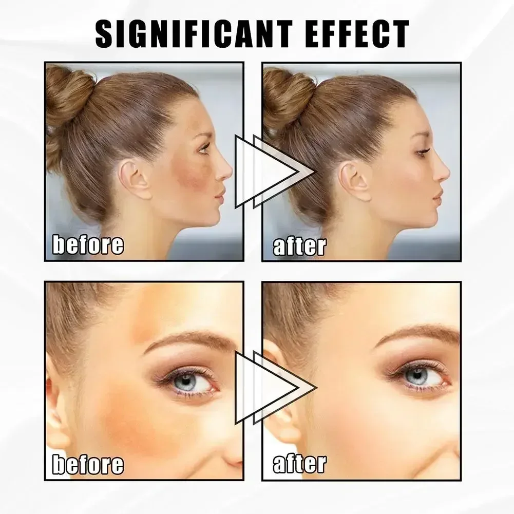 Отбеливающий крем для удаления веснушек осветляющий тон удаление темных пятен