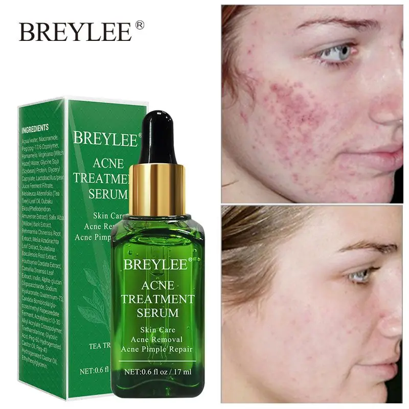 

BREYLEE Acne Removal Serum Treatment Acne Scar Spots Shrink Pores Face Essence Whitening Oil Control Soothing Repair Skin Care