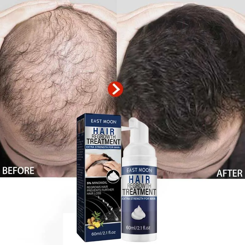 

Hair Growth Product Hair Thick Mousse Promote Hair Growth Nourish Scalp Repair Damaged Hair Care Baldness Remedy Boost Grow 60ml