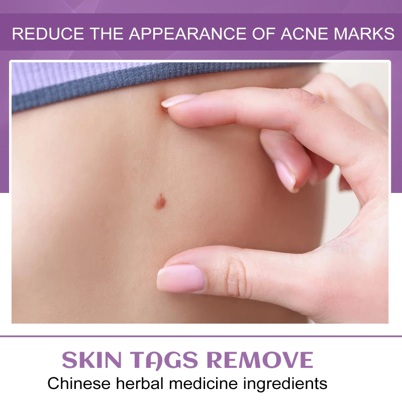 

Средство для удаления бородавок, жидкая женская искусственная ручка для удаления бородавок, прыщей, патч для удаления черных точек, красота...