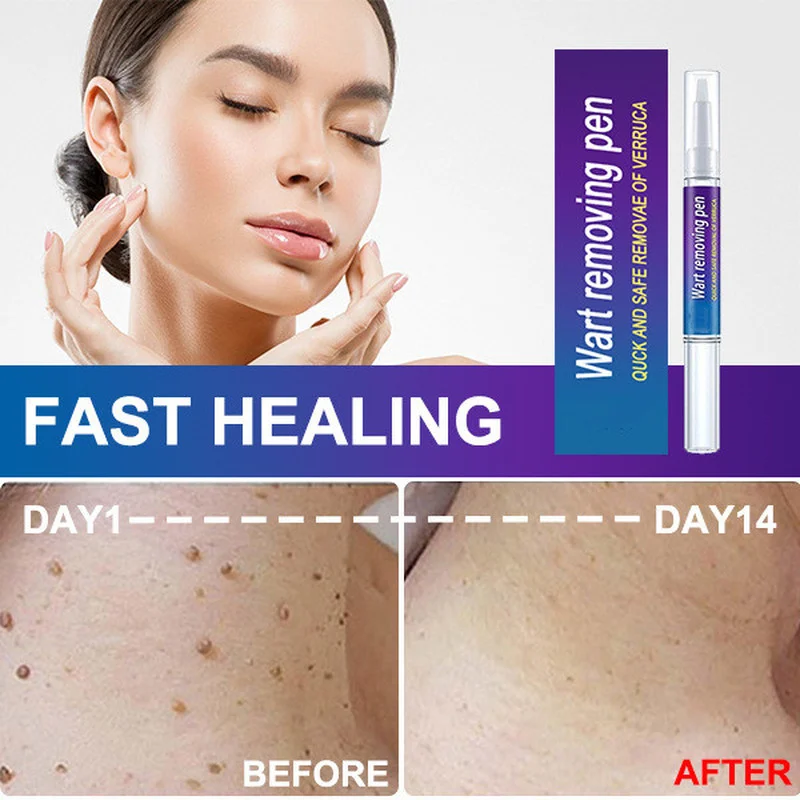 

Removing Against Moles Liquid Pen Treatment Papillomas Removal Of Warts Liquid From Skin Tags Remover Anti Verruca Remedy