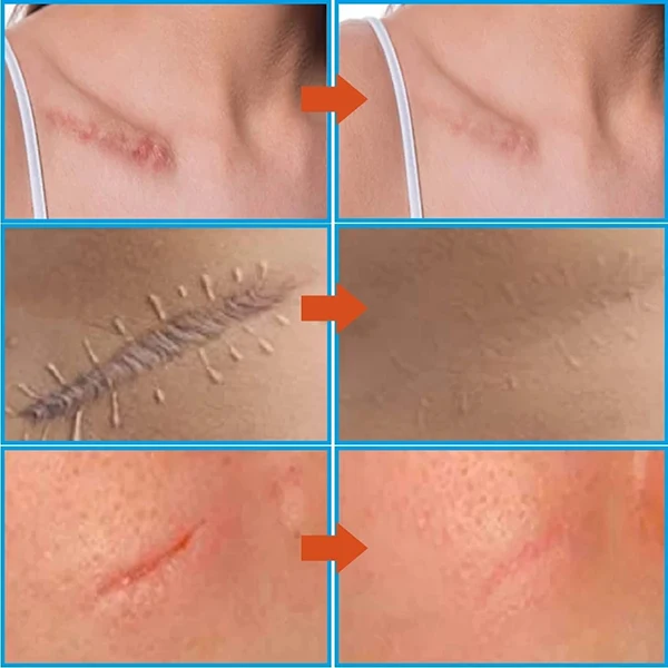 Лазерная ручка для лечения морщин и варикозного расширения вен |