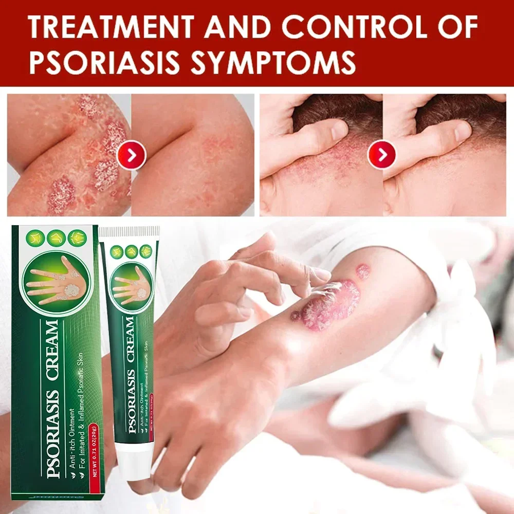 Крем от псориаза дерматита экзематоида антибактериальный эффективный против