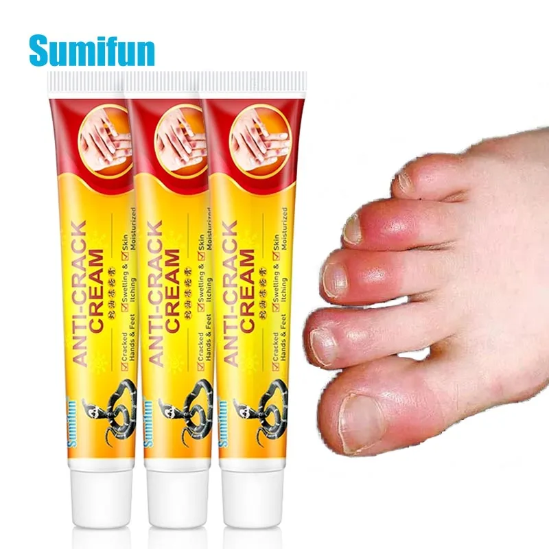 

Sumifun, 1/3 шт., медицинский крем для рук, лечебный пилинг, восстанавливающая мазь, замораживание, крем для сухой кожи с трещинами, 20 г