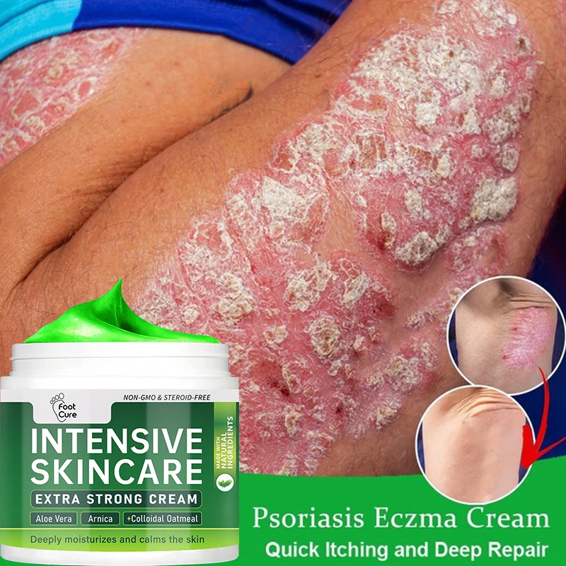 

Psoriasis Dermatitis Eczematoid Eczema Ointment Anti-Itch Chinese Herb Medical Skin Care Cream 15/30/50g