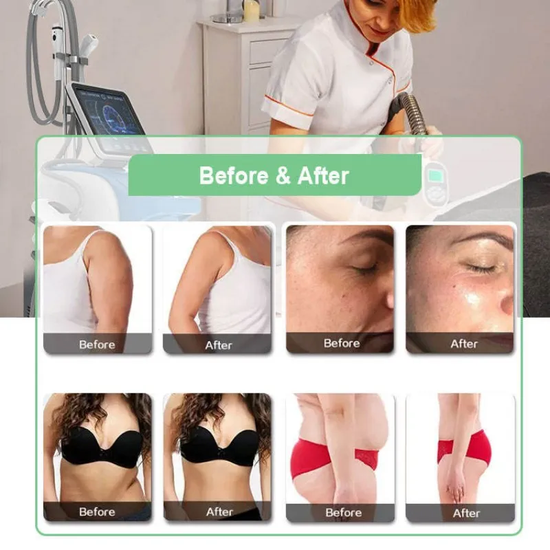 Vela аппарат для похудения кавитация фотоэлектрический ролик радиочастотный