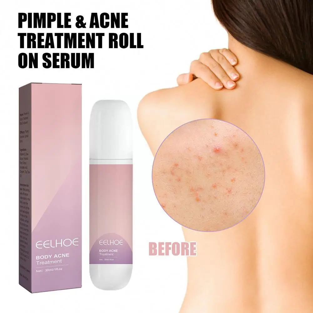

Body Acne Treatment Rolling Ball Clears Skin Removes Essence Marks Relieves Acne Fade Acne Inflammation Care Buttocks Skin F7J8