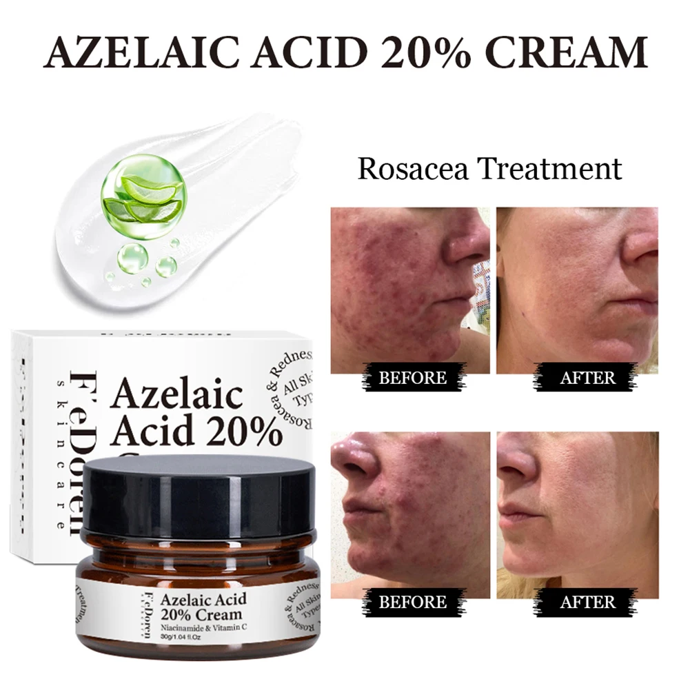 

Azelaic Acid 20% Whitening Fades Acne Cream Freckle Remove Melasma Dark Pigment Spots Melanin Alpha Arbutin Face Cream Skin Care