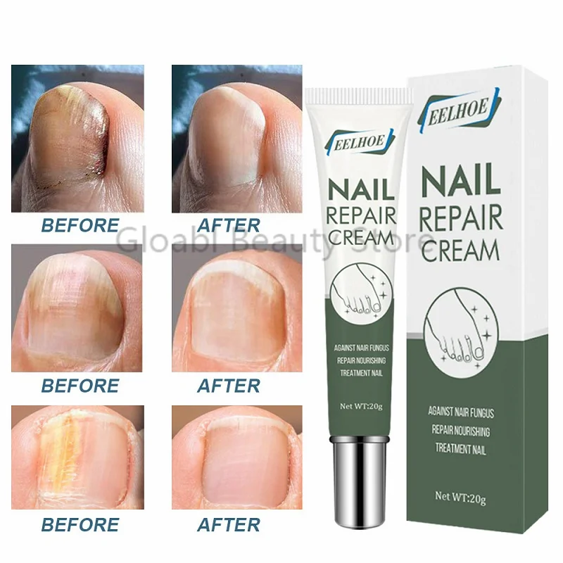 

Anti Fungal Nail Repair Paronychia Infection Onychomycosis Toe Finger Nails Fungus Nourishing Brighten Nail Treatment 20gmakeup