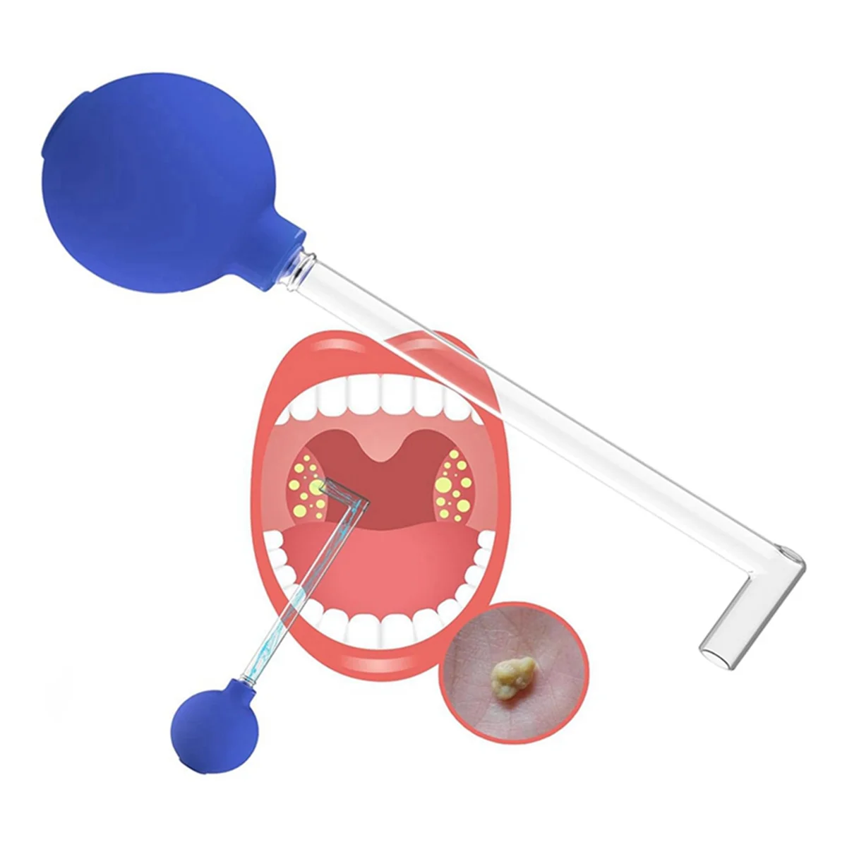 Вакуумный инструмент для удаления миндалин набор ручная стильная очистка рта