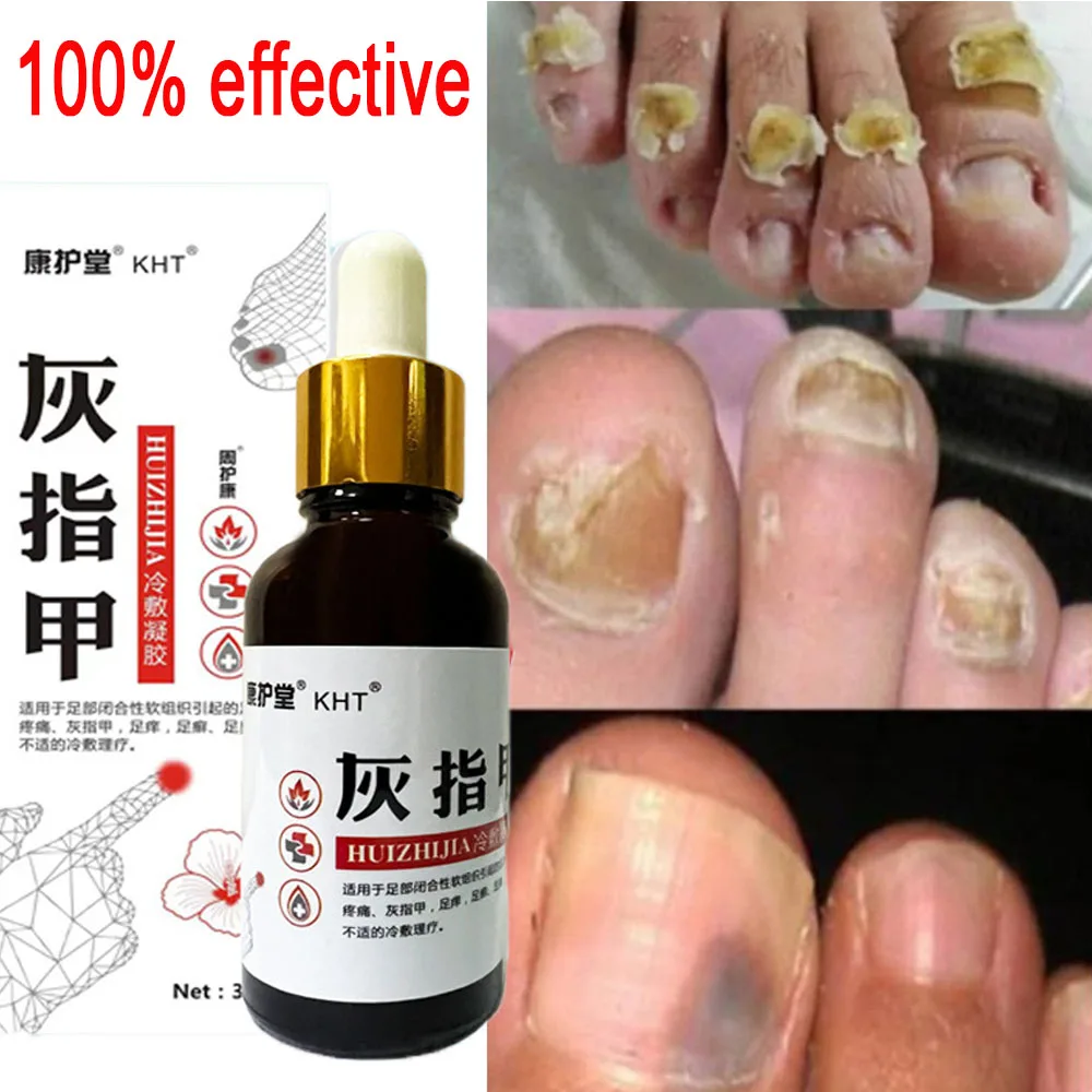 

Nail Fungal Treatment Feet Care Essence Nail Foot Whitening Toe Nail Fungus Removal Gel Anti Infection Paronychia Onychomycosis