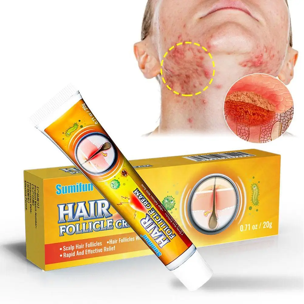 

Folliculitis Cream Scalp Hair Folliculitis Treatment Ointment Cysts Papules Spot Remover Skin Anti Itching Ulcers Medicine