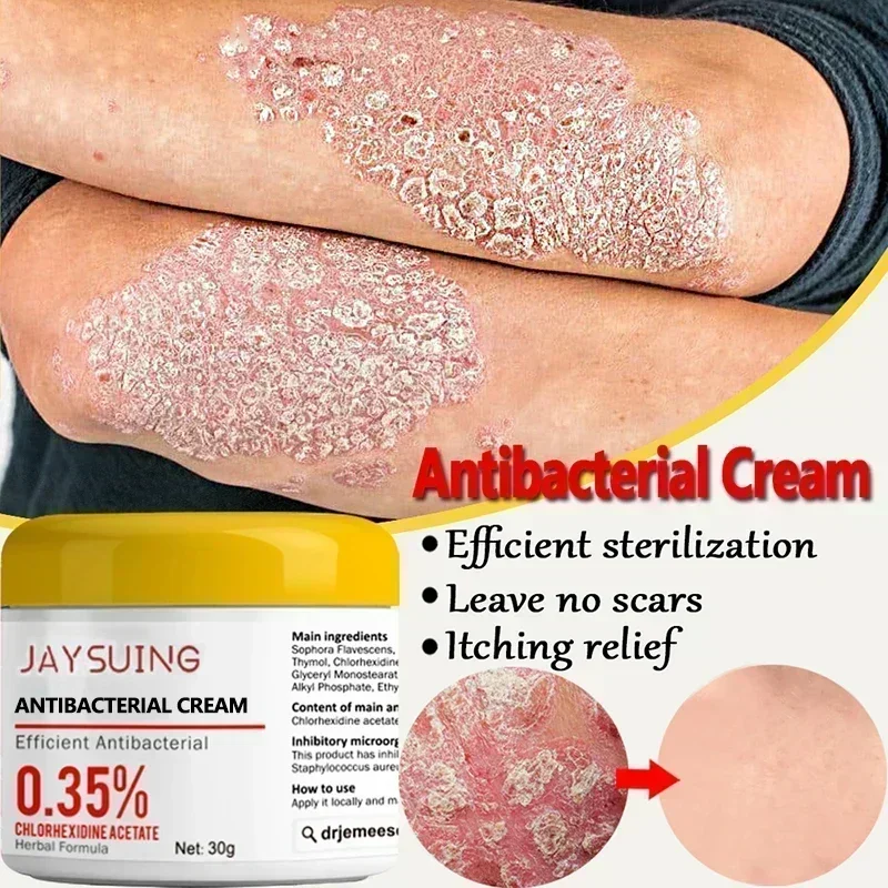 HOT SALE Treatment of stubborn psoriasis moss special drug ointment body and thigh dermatosis itching antibacteri