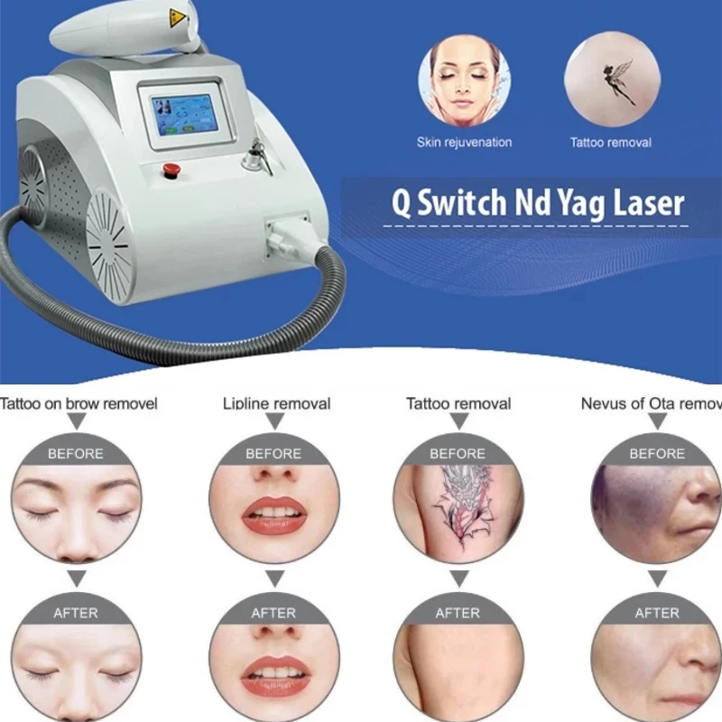 

Pico Picosecond Portable Q-Switched Nd Yag Laser 1064nm 532nm 1320nm Carbon Laser Peeling Tattoo Speckle Removal CE Machine
