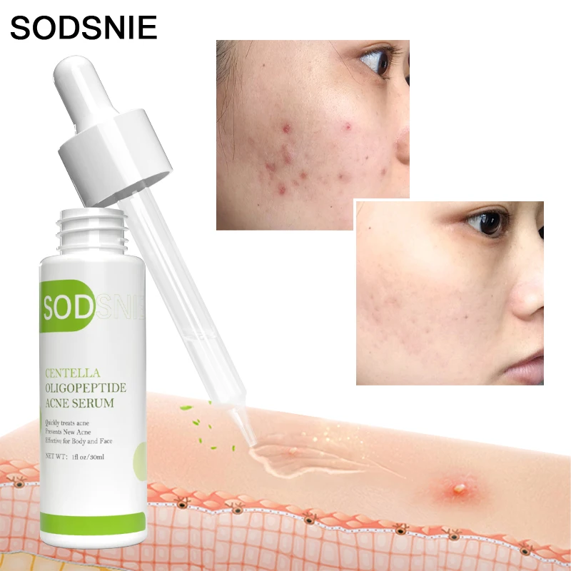 

Centella Acne Serum Remove Pimples Moisturize Shrink Pores Oil Control Anti-Inflammatory Acne Treatment Brighten Skin Care 30ml