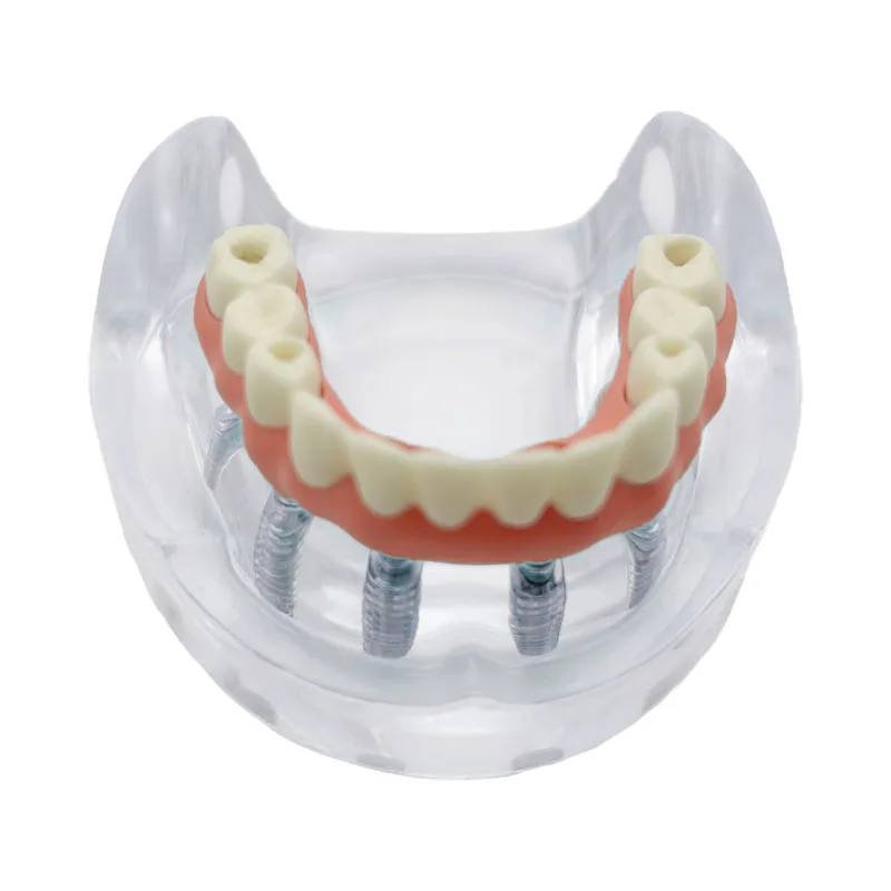 1 шт. модель зубного имплантата 6 имплантатов реставрация зубов стоматолог